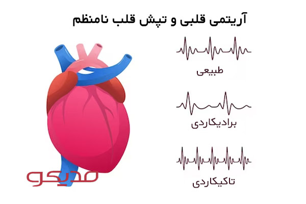 آریتمی قلبی